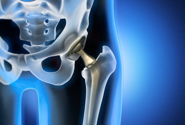 Affordable total hip replacement in india