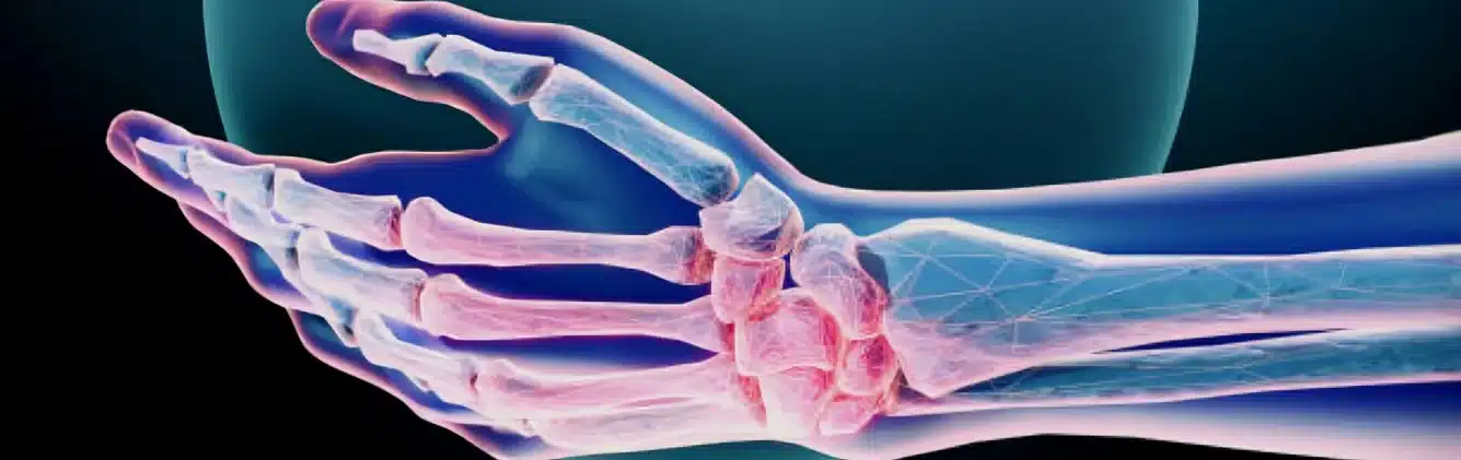Hand Xray Arthritis Symptoms