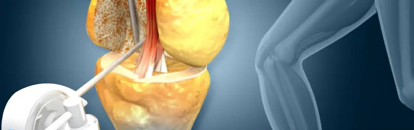 Knee Ligament Repair Surgery Arthroscopy