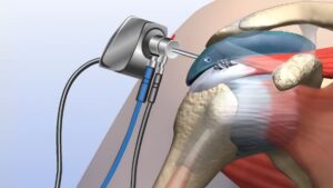 Rotator cuff repair surgery with arthroscopic tools on shoulder joint