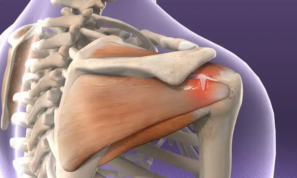 Shoulder Muscle Tendon Tear