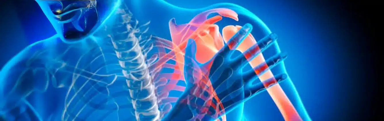 Shoulder Pain Illustration