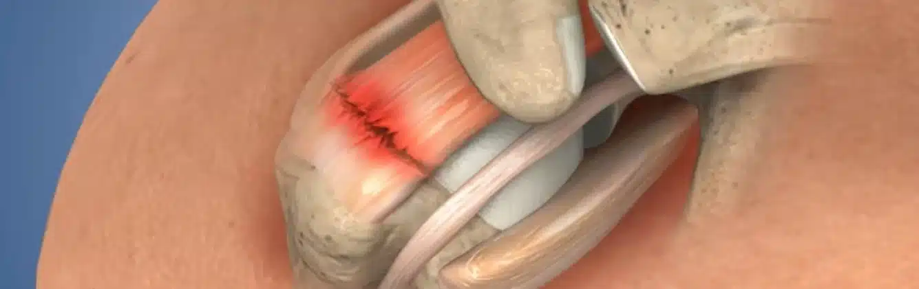 Surgical Repair Torn Muscle Ligament
