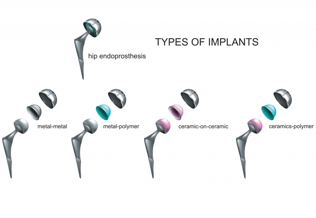 Hip-Implants